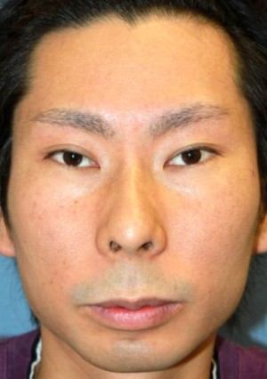 術前正面