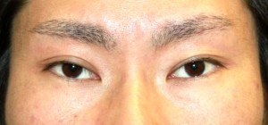 術前正面アップ
