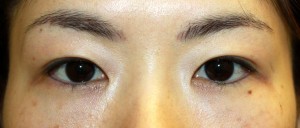 術前正面開瞼