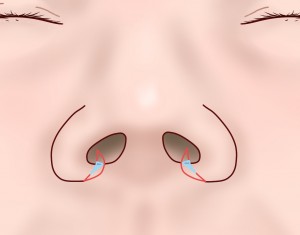 鼻翼縮小Ⅲ③