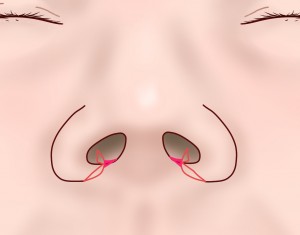 鼻翼縮小Ⅲ④