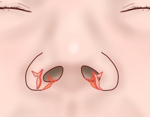 鼻翼縮小Ⅲ⑤