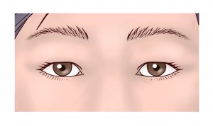 上瞼リフト（改）①