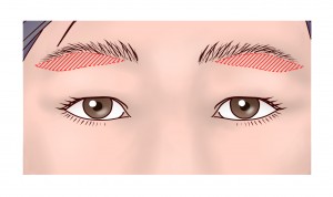 上瞼リフト（改）②