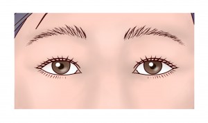 上瞼リフト（改）③