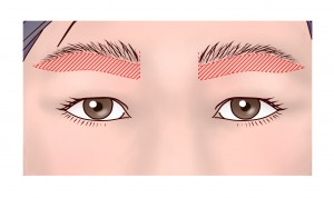 上瞼リフト（改）④