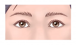 上瞼リフト（改）⑤