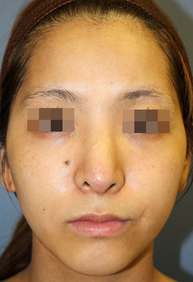 BS 鼻中隔延長術＋他院鼻プロテーゼ修正術＋鼻尖縮小術 症例経過写真