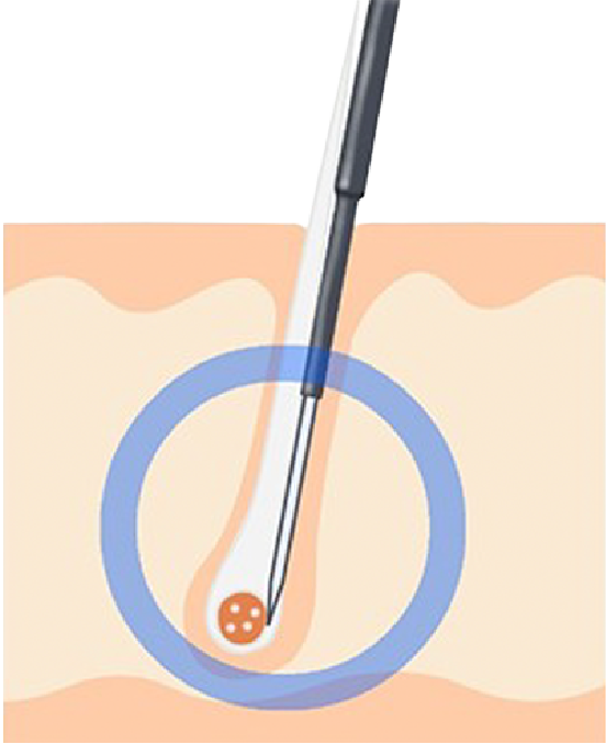 絶縁針脱毛のイメージ