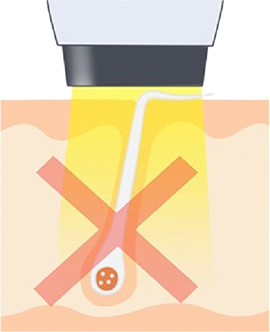 レーザー脱毛のイメージ