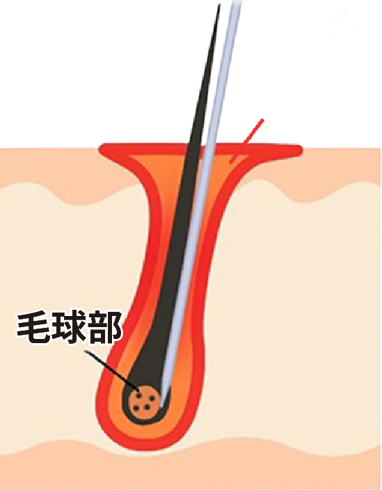 非絶縁針による脱毛イメージ