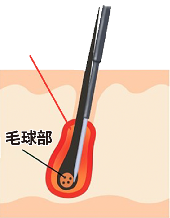 絶縁針による脱毛イメージ