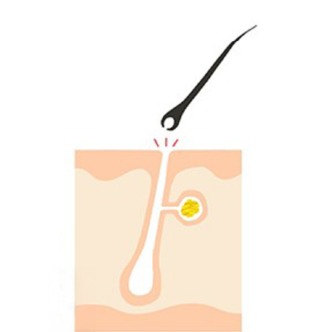 毛が抜け落ちるステップ