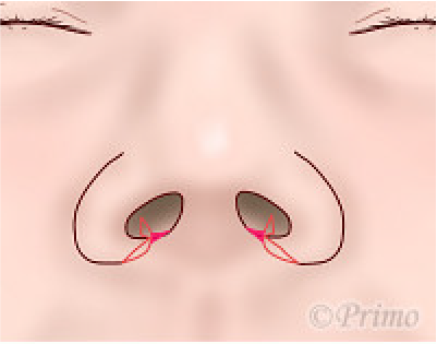 鼻翼縮小術の工夫