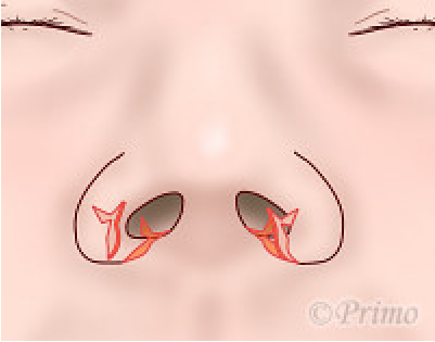 鼻翼縮小術の工夫