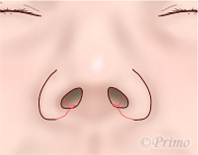 鼻翼縮小術の工夫