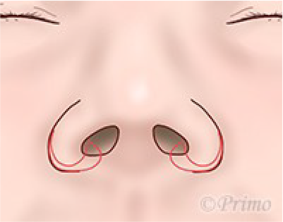 鼻翼縮小術の工夫