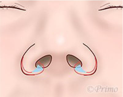 鼻翼縮小術の工夫