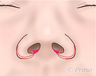 鼻翼縮小術の工夫