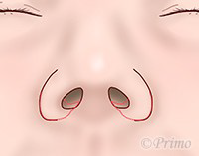 鼻翼縮小術の工夫