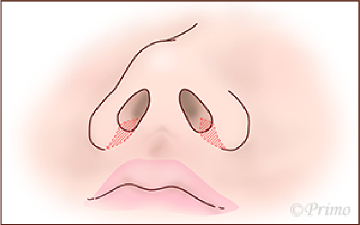 鼻翼縮小術方法