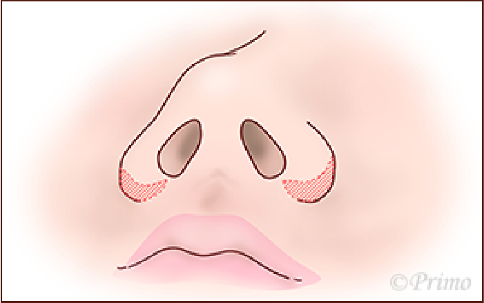 鼻翼縮小術方法