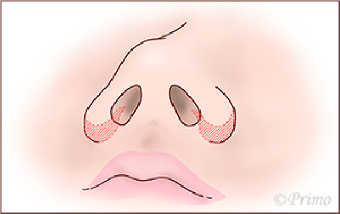 鼻翼縮小術方法