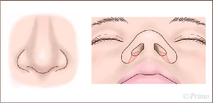 鼻翼縮小術方法