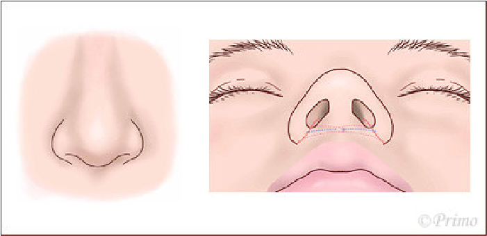 鼻翼縮小術方法