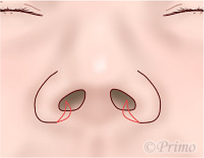 鼻翼縮小術の工夫