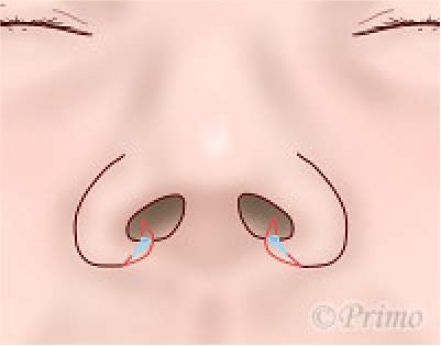 鼻翼縮小術の工夫