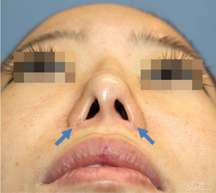 鼻翼修正術症状