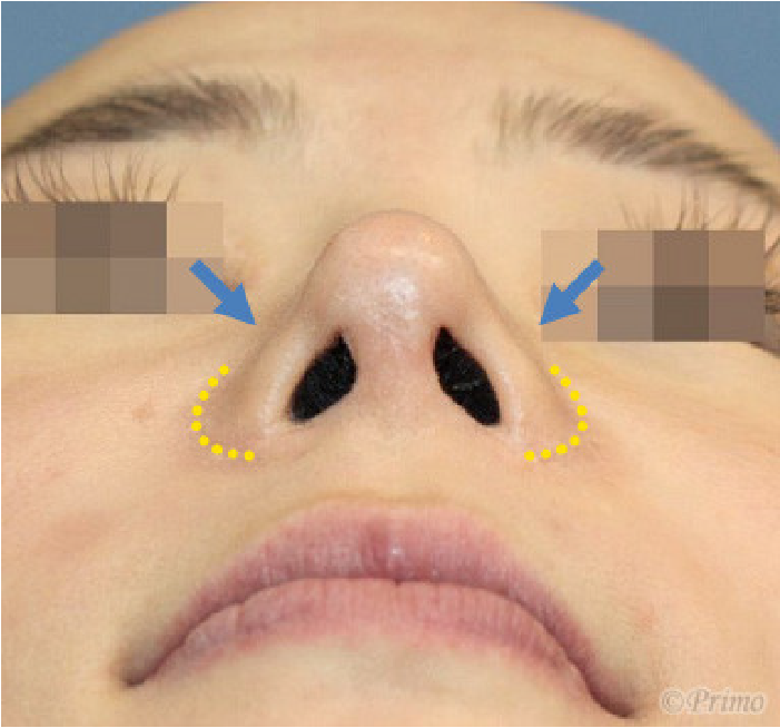 鼻翼修正術症状