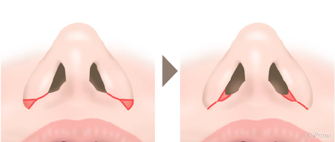 鼻翼修正術症状