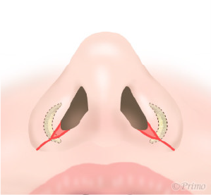 鼻翼修正術症状