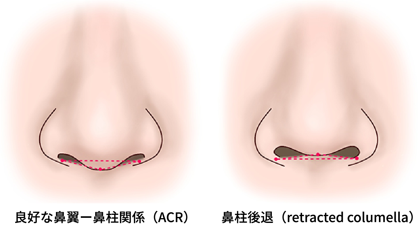 鼻柱と鼻翼の位置関係