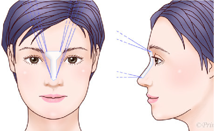 眉間プロテーゼ方法