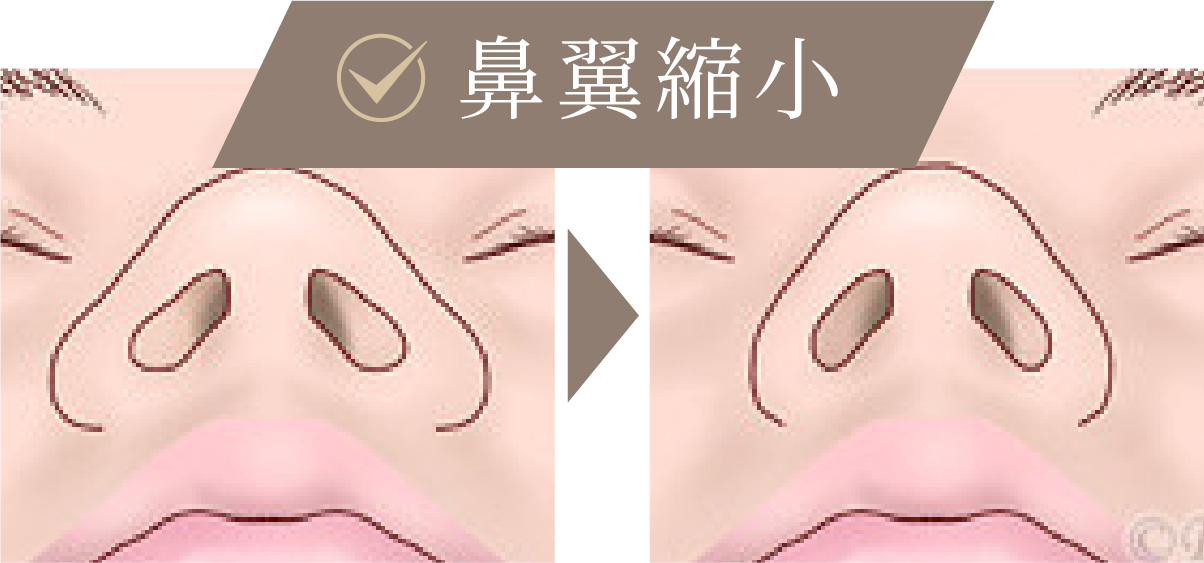 鼻翼縮小の比較イメージ