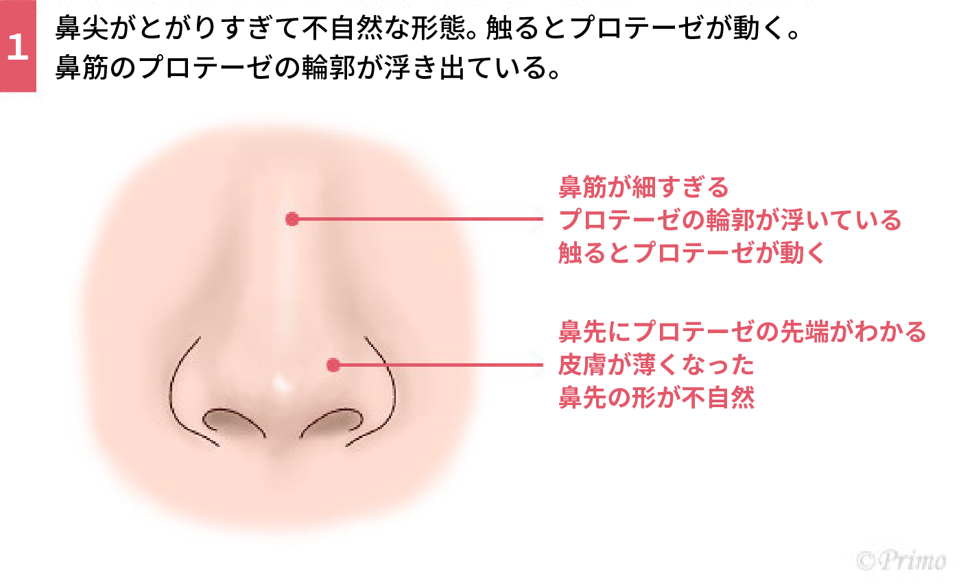 鼻プロテーゼ抜去術トラブル例