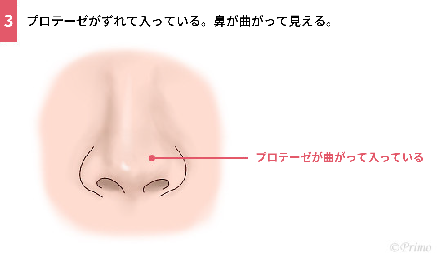 鼻プロテーゼ抜去術トラブル例