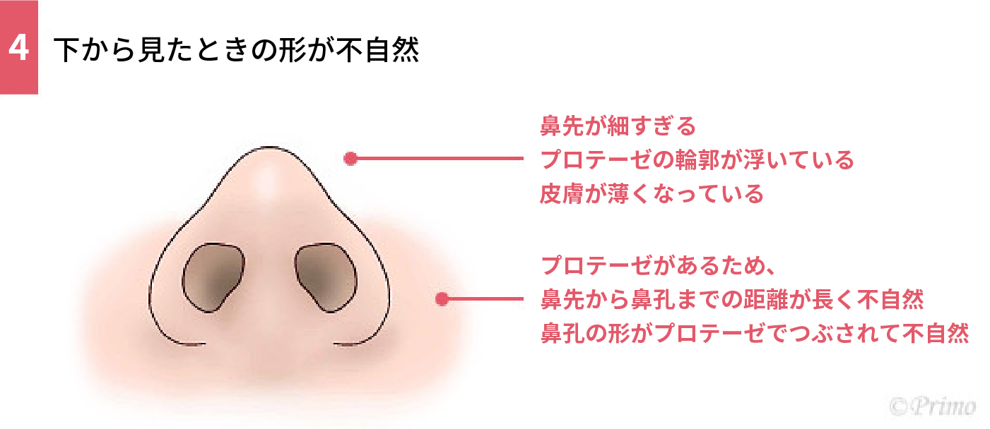鼻プロテーゼ抜去術トラブル例