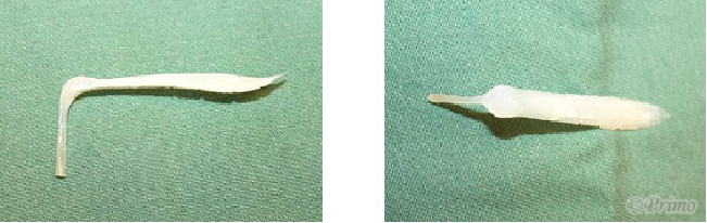 鼻プロテーゼ抜去術トラブル例