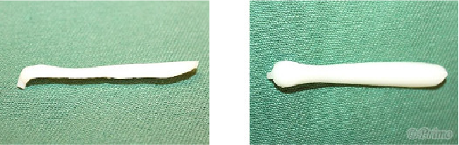 鼻プロテーゼ抜去術トラブル例