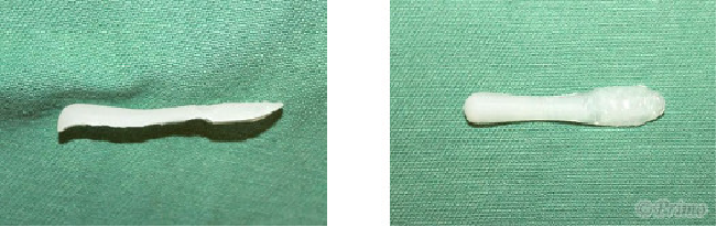 鼻プロテーゼ抜去術トラブル例