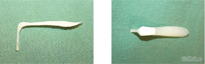 鼻プロテーゼ抜去術トラブル例