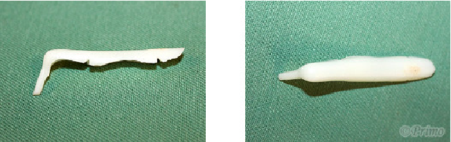 鼻プロテーゼ抜去術トラブル例