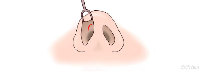 鼻プロテーゼ抜去術