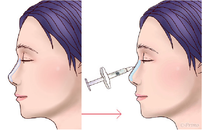 鼻プロテーゼ抜去術