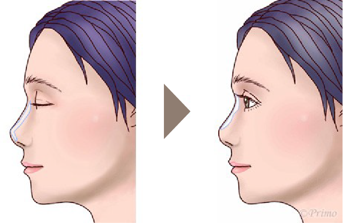 鼻プロテーゼ入れ替え術