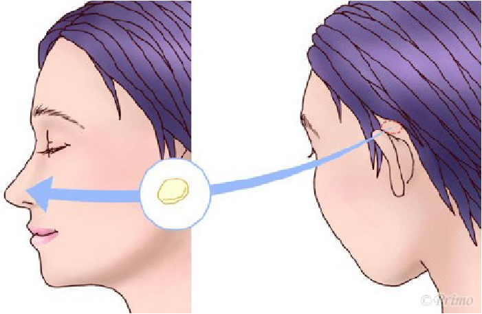 鼻プロテーゼ入れ替え術